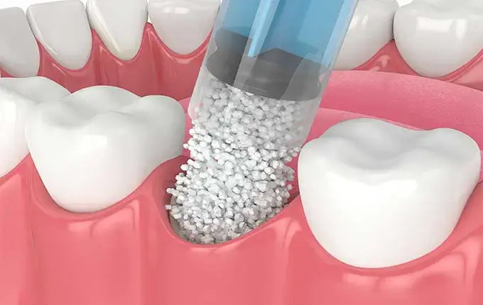 پیوند استخوان فک توسط دکتر رضا امیرزرگر فوق تخصص جراحی زیبایی صورت فک دهان دندان