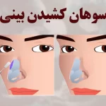 رسپینگ بینی یا سوهان کشیدن بینی چیست و چگونه انجام میشود ؟