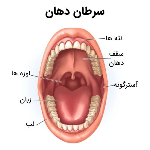 سرطان زبان و درمان توسط دکتر رضا امیرزرگر فوق تخصص جراحی زیبایی صورت فک دهان دندان