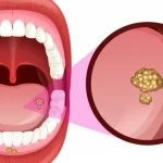 سرطان ، تومور و کیست های دهانی چیست و درمان آن