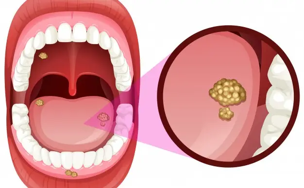 جراحی کیست تومور و ضایعه دهانی توسط دکتر رضا امیرزرگر فوق تخصص جراحی زیبایی صورت فک دهان دندان