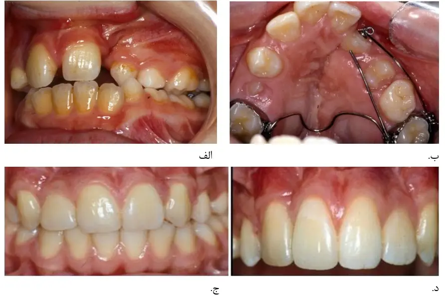 اصلاح فک در شکاف کام یا لب شکری توسط دکتر رضا امیرزرگر فوق تخصص جراحی زیبایی صورت فک دهان دندان 