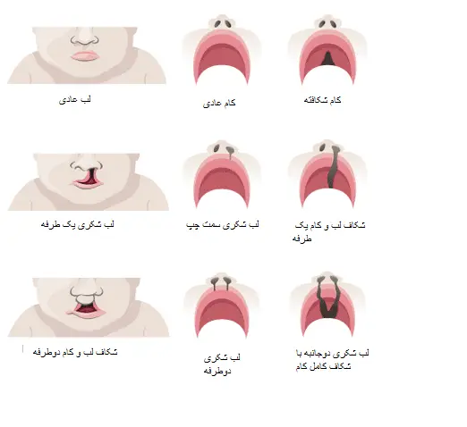 انواع شکاف کام یا لب شکری و درمان توسط دکتر رضا امیرزرگر فوق تخصص جراحی زیبایی صورت فک دهان دندان