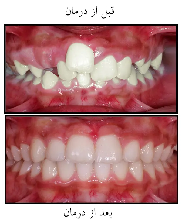 دندان نهفته و درمان و جراحی آن توسط دکتر رضا امیرزرگر فوق تخص جراحی زیبایی صورت فک دهان دندان