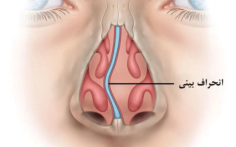 جراحی استئوتومی و انحراف بینی و درمان توسط دکتر رضا امیرزرگر فوق تخصص جراحی زیبایی صورت فک دهان دندان