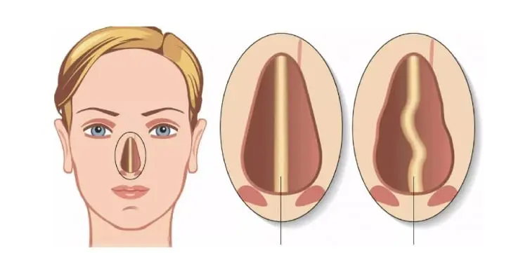 استئوتومی جراحی زیبایی بینی توسط دکتر رضا امیرزرگر فوق تخصص جراحی زیبایی صورت فک دهان دندان