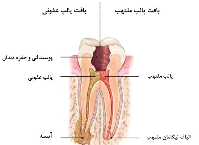 آبسه دندان و درمان توسط دکتر رضا امیرزرگر فوق تخصص جراحی زیبایی صورت فک دهان دندان