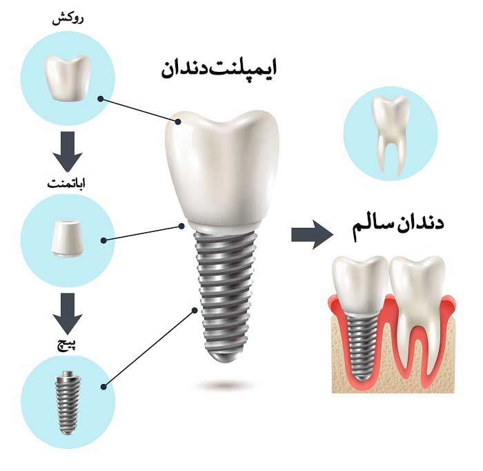 ایمپلنت و جراحی زیبایی توسط دکتر رضا امیرزرگر فوق تخصص جراحی زیبایی صورت فک دهان دندان