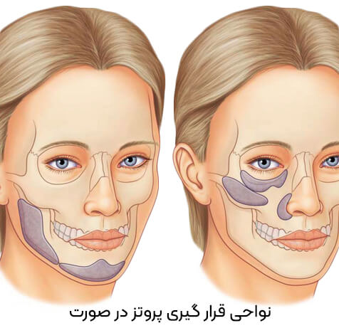 پروتز صورت توسط دکتر رضا امیرزرگر فوق تخصص جراحی زیبایی صورت فک دهان و دندان