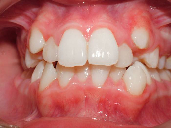 درمان لبخند لثه ای توسط فوق تخصص جراحی زیبایی صورت و فک و دهان و دندان توسط دکتر رضا امیرزرگر