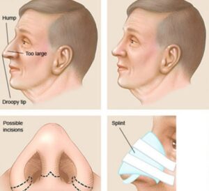 اسپلینت بینی بعد از عمل توسط دکتر رضا امیرزرگر فوق تخصص جراحی زیبایی فک صورت دهان دندان در کلینیک زیبایی تهران