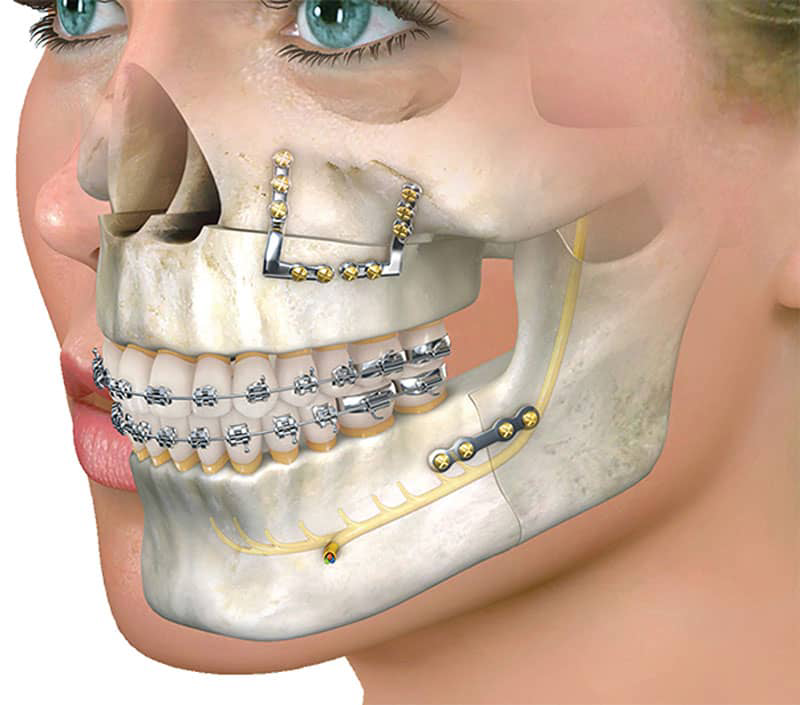 جراحی و اصلاح فک توسط دکتر رضا امیرزرگر فوق تخصص جراحی زیبایی صورت دهان دندان