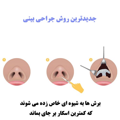 انواع جراحی بینی و جراحی زیبایی توسط دکتر رضا امیرزرگر فوق تخصص جراحی زیبایی صورت فک دهان دندان