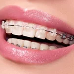 ارتودنسی دندان چیست، انواع و تفاوت آن‌ها با یکدیگر