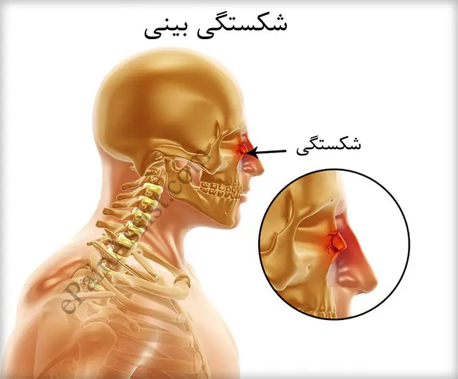 جراحی شکستگی بینی توسط دکتر رضا امیرزرگر فوق تخصص جراحی زیبایی صورت فک دهان دندان