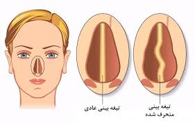 رینوپلاستی توسط دکتر رضا امیرزرگر فوق تخصص جراحی زیبایی صورت فک دهان دندان