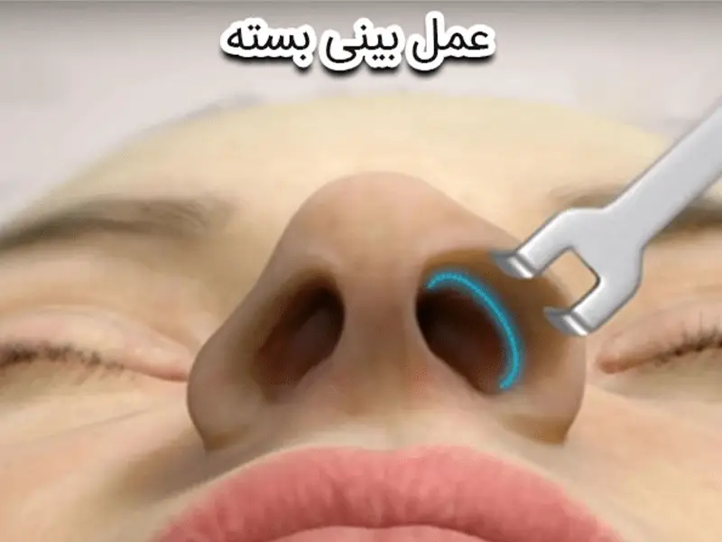 عمل بینی بسته توسط دکتر رضا امیرزرگر فوق تخصص جراحی زیبایی صورت فک دهان دندان