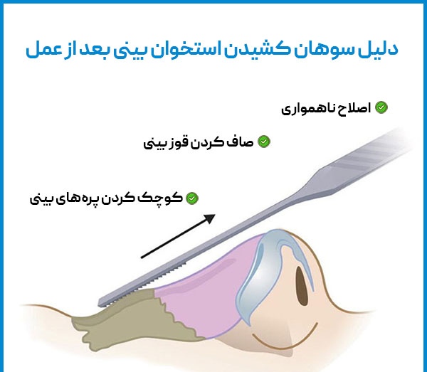 رسپینگ سوهان کشیدن بینی توسط دکتر رضا امیرزرگر فوق تخصص جراحی زیبایی صورت فک دهان دندان