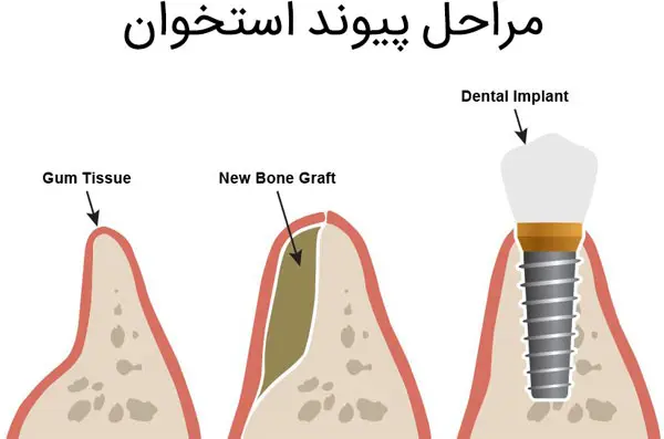 پیوند مغز استخوان فک توسط دکتر رضا امیرزرگر فوق تخصص جراحی زیبایی صورت فک دهان دندان