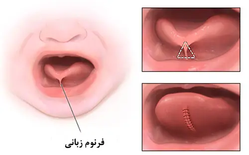 فرنوم لب و زبانی و درمان توسط دکتر رضا امیرزرگر فوق تخصص جراحی زیبایی صورت فک دهان دندان