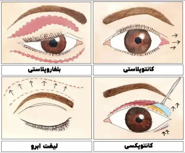 جراحی زیبایی چشم توسط دکتر رضا امیرزرگر فوق تخصص جراحی زیبایی صورت فک دهان دندان