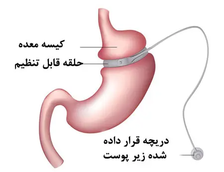 جراحی لاغری و انواع آن توسط دکتر رضا امیرزرگر فوق تخصص جراحی زیبایی صورت فک دهان دندان